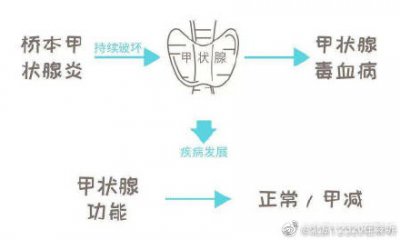 ​桥本氏甲状腺炎饮食 桥本氏甲状腺炎患者的饮食调理应注意
