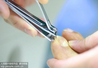 ​“甲母痣”会恶变为黑色素瘤？专家教你判别