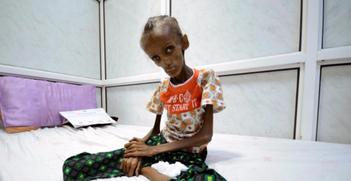 营养不良主要是指缺乏什么