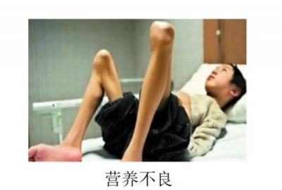 ​什么是营养不良,营养不良和营养过剩的区别