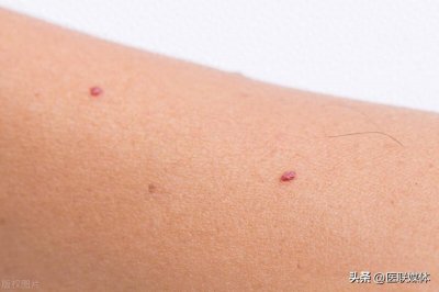 ​身上长了“红痣”，是肝病的信号？痣有这3个变化，得小心了