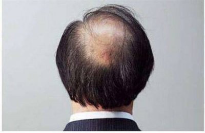 ​地中海是什么意思（形容一个人地中海是什么意思）