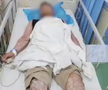 ​红火蚁再伤人！广东一男子被咬伤后，全身起泡倒地休克！有多毒？