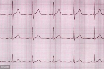 ​窦性心动过速是什么意思严重吗(窦性心动过速是病吗)