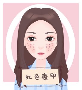 ​脸上痘印怎么最快淡化