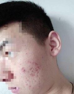 ​消痘痘最快的方法(痘痘最快好的方法)