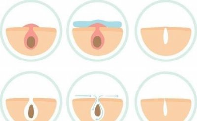 毛孔粗怎么解决(毛孔粗大怎么办)